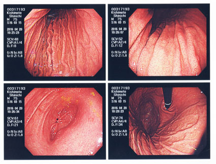 初めての胃カメラ写真